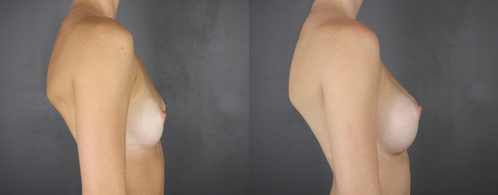 Case--5426 | Before and After Breast Augmentation 3