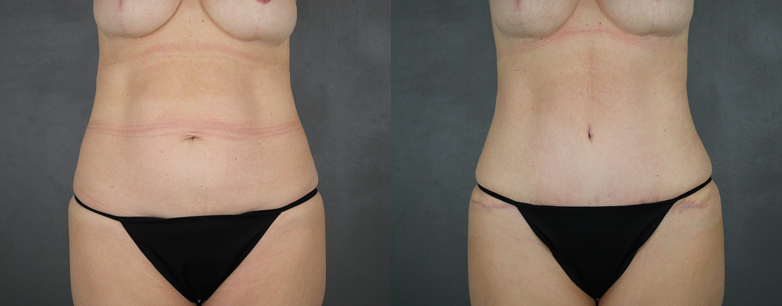 Case--1587 | Before and After Tummy Tuck