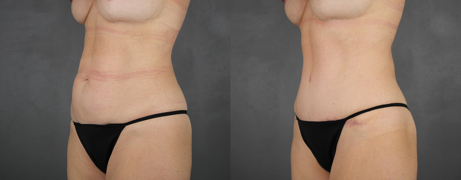 Case--1587 | Before and After Tummy Tuck 2