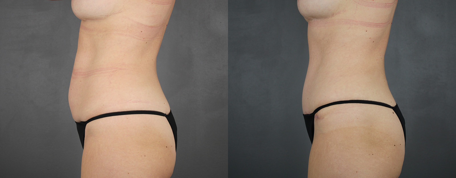 Case--1587 | Before and After Tummy Tuck 3