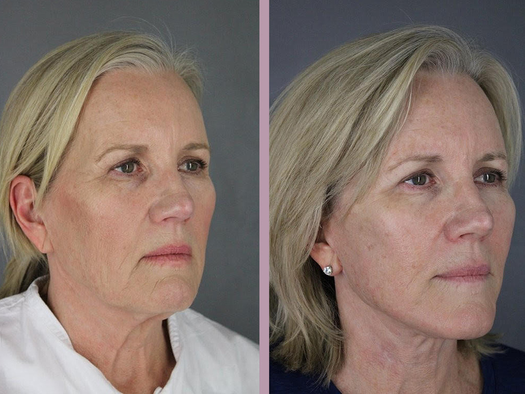Lip Lift - Before and After Patient Results - 2