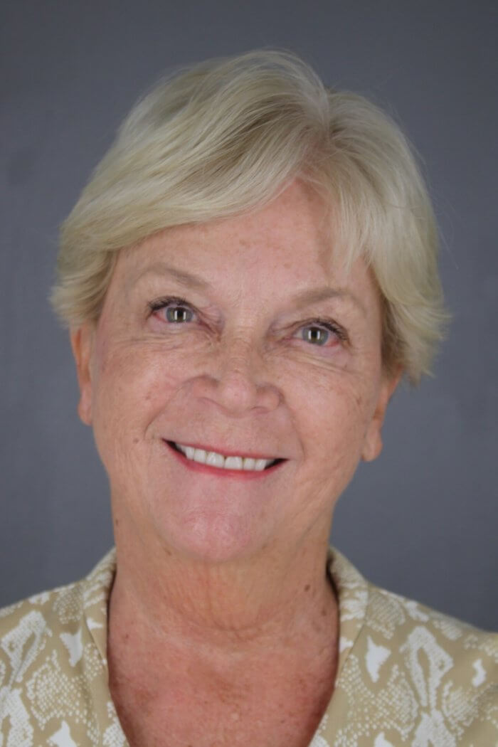 Case--1577 | Before Lip Lift