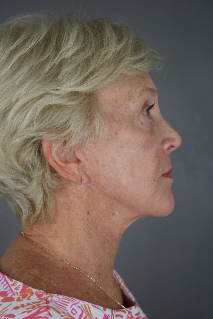 Case--1577 | After Lip Lift 5