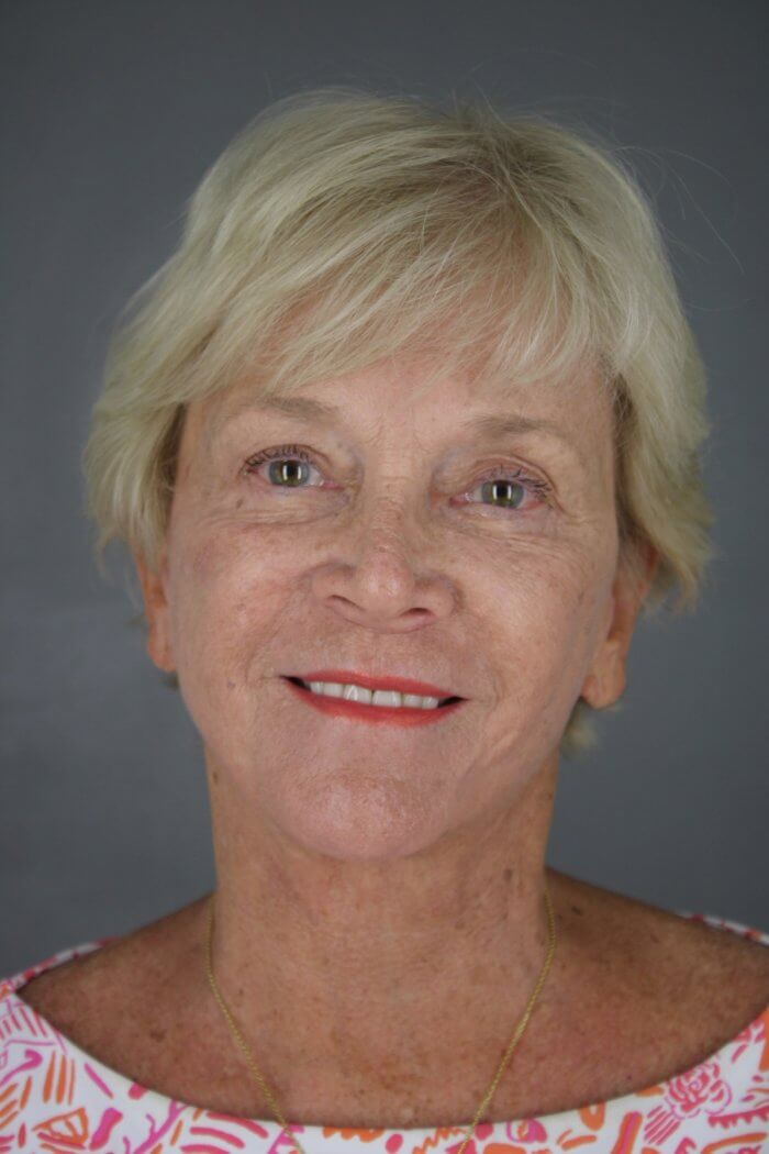 Case--1577 | After Lip Lift