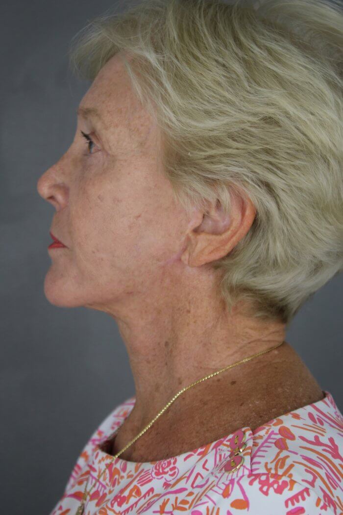 Case--1577 | After Lip Lift 3