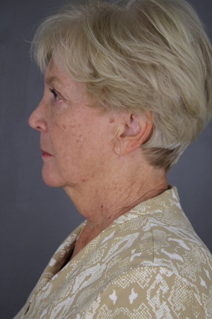 Case--1577 | Before Lip Lift 3