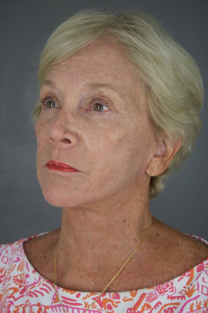 Case--1577 | After Lip Lift 2