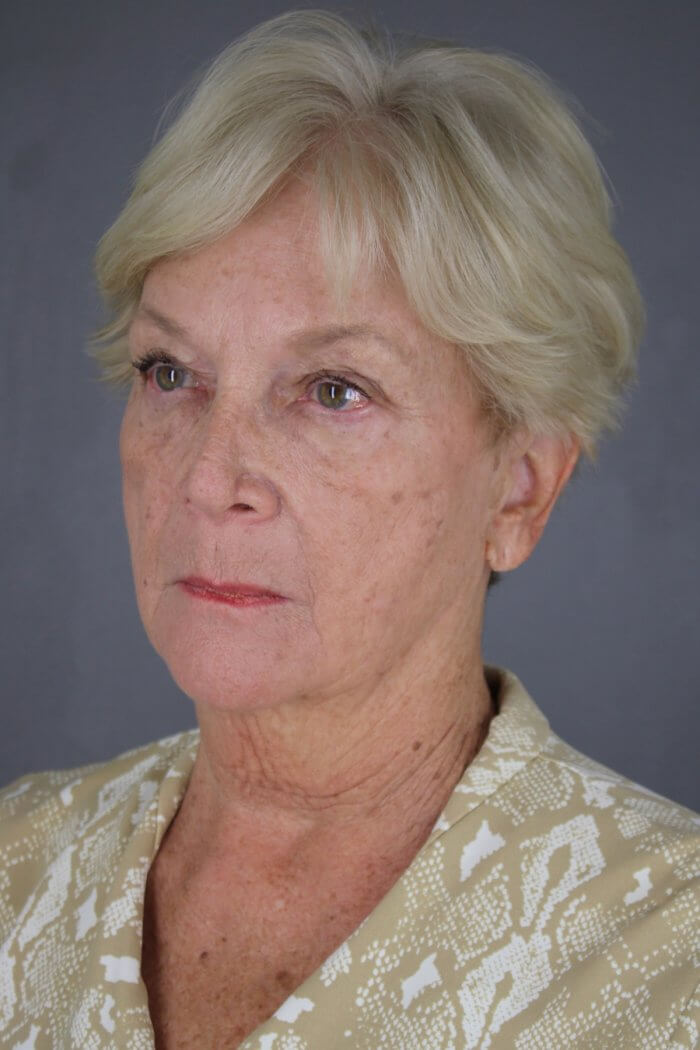 Case--1577 | Before Lip Lift 2