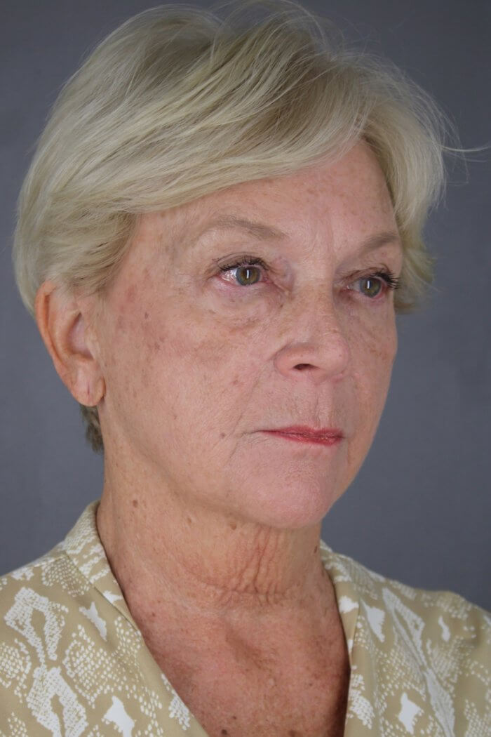 Case--1577 | Before Lip Lift 4