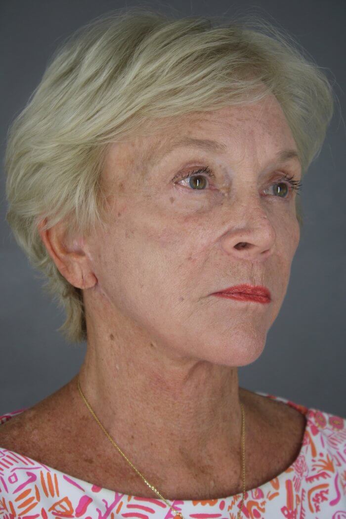 Case--1577 | After Lip Lift 4