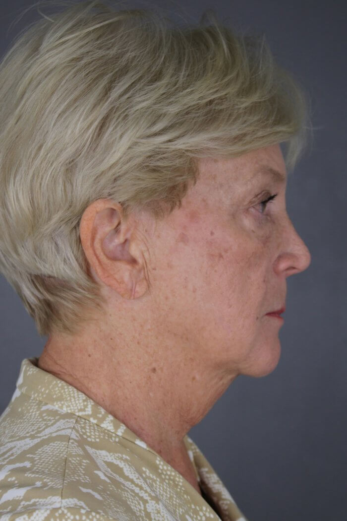 Case--1577 | Before Lip Lift 5