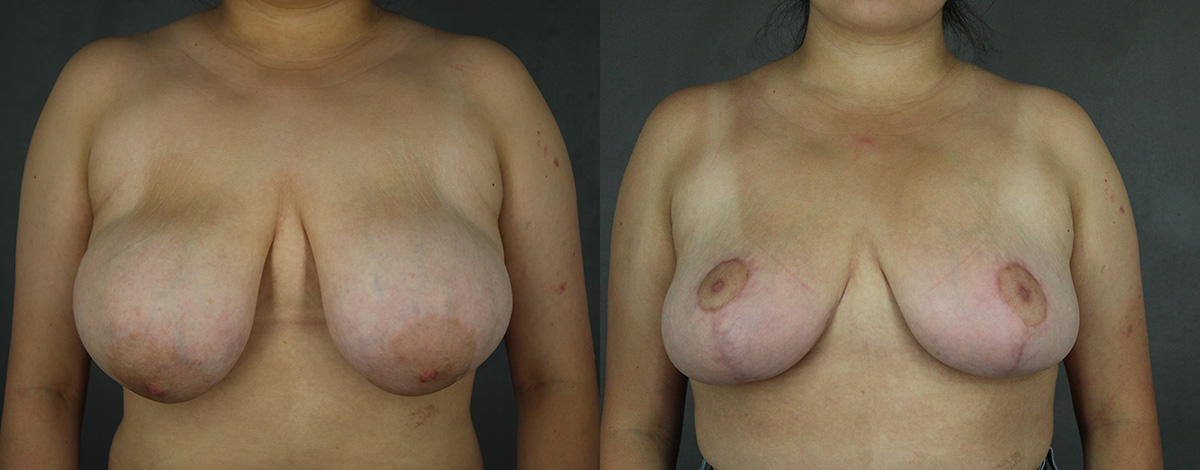 Case--8269 | Before and After Breast Reduction