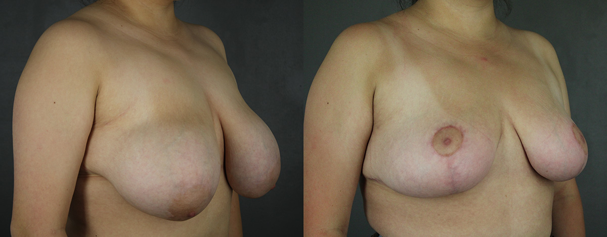 Case--8269 | Before and After Breast Reduction 2
