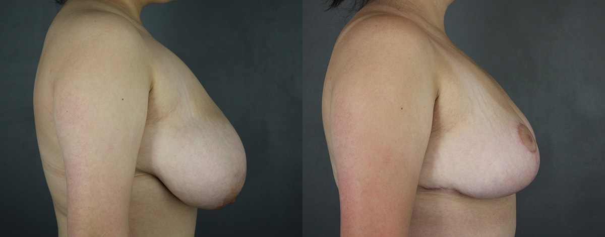 Case--8269 | Before and After Breast Reduction 3