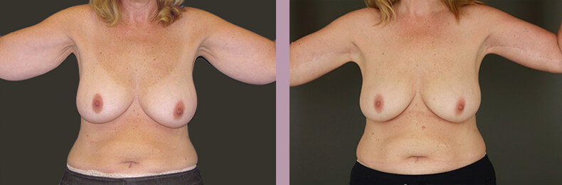 Arm Lift - Before and After Patient Results - 1
