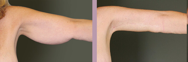 Case--14880 | Before and After Arm Lift 2