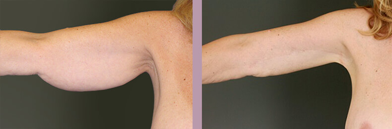 Case--14880 | Before and After Arm Lift 3