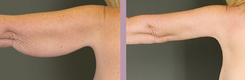 Case--14880 | Before and After Arm Lift 4