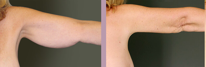 Case--14880 | Before and After Arm Lift 5