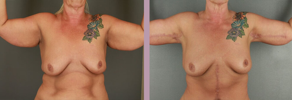 Arm Lift - Before and After Patient Results - 3