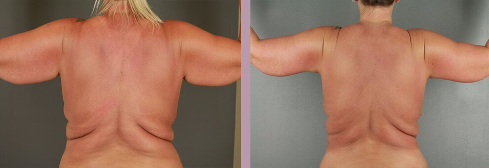 Case--22444 | Before and After Arm Lift 2