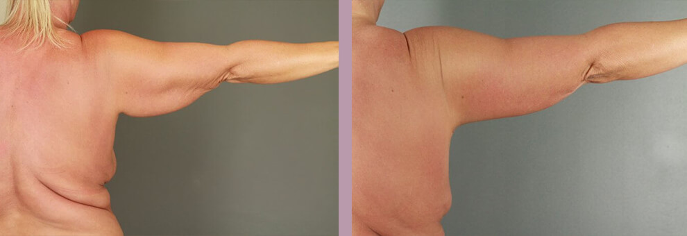 Case--22444 | Before and After Arm Lift 3
