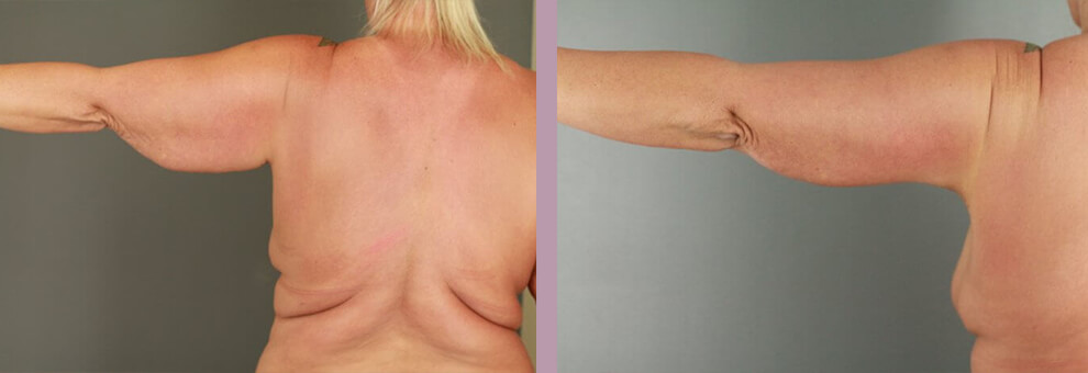 Case--22444 | Before and After Arm Lift 4