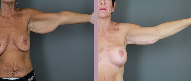 Case--6257 | Before and After Arm Lift