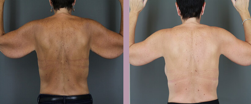 Case--6257 | Before and After Arm Lift 2