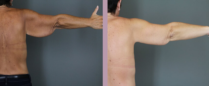 Case--6257 | Before and After Arm Lift 3