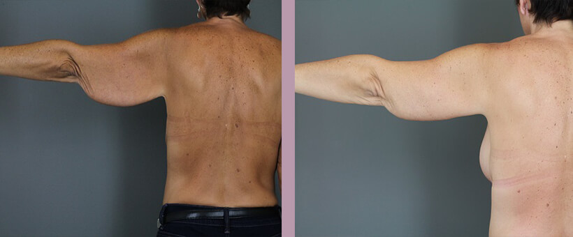 Case--6257 | Before and After Arm Lift 4