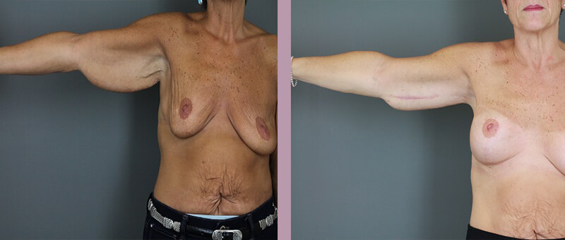 Case--6257 | Before and After Arm Lift 5