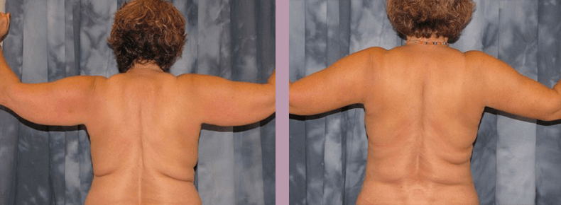 Arm Lift - Before and After Patient Results - 2