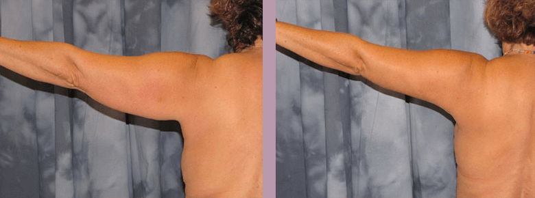 Case--810 | Before and After Arm Lift 2