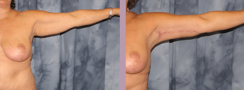 Case--810 | Before and After Arm Lift 3