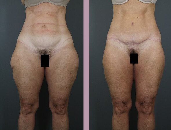 Body Lift - Before and After Patient Results - 1
