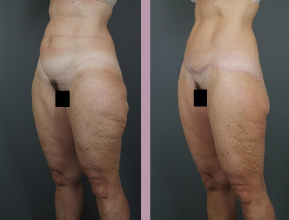 Body Lift - Before and After Patient Results - 2