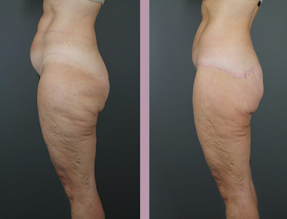 Body Lift - Before and After Patient Results - 3