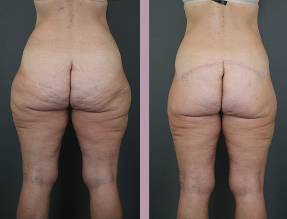 Case--16440 | Before and After Body Lift 4