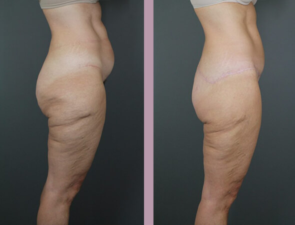 Case--16440 | Before and After Body Lift 5