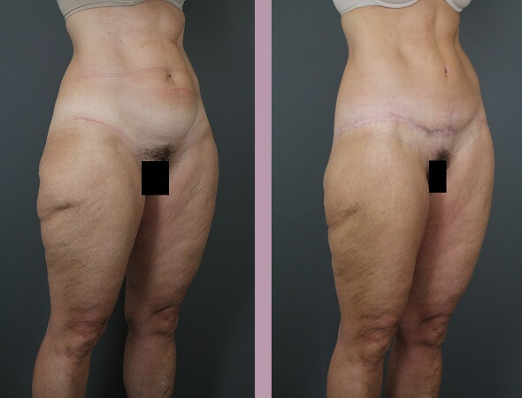 Case--16440 | Before and After Body Lift 6