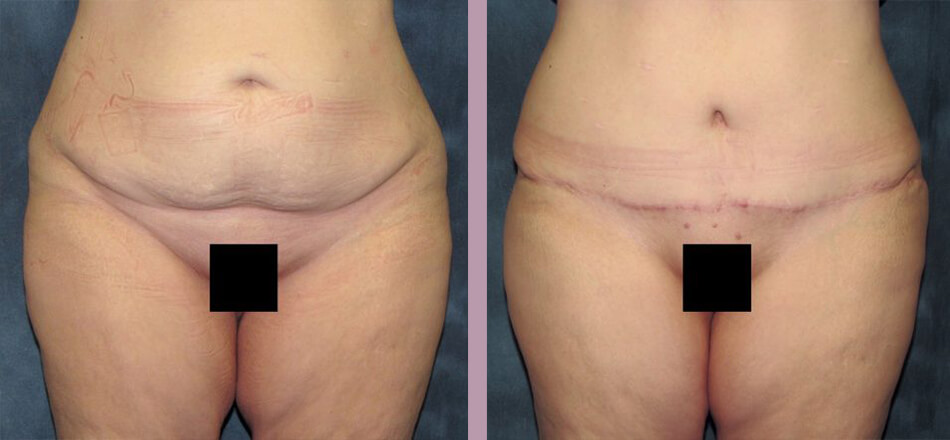 Thigh Lift - Before and After Patient Results - 1