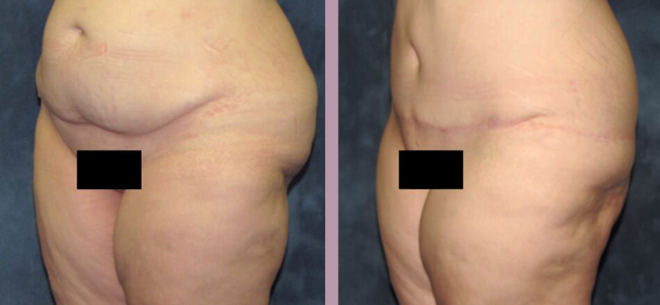 Thigh Lift - Before and After Patient Results - 2