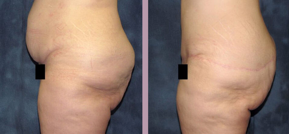 Thigh Lift - Before and After Patient Results - 3