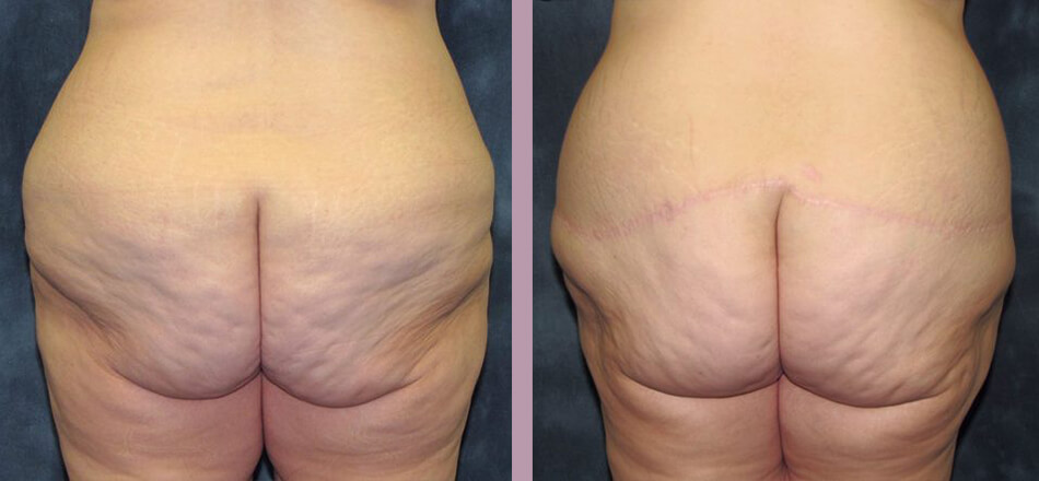 Case--16456 | Before and After Body Lift 4