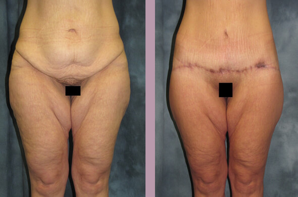 Case--831 | Before and After Body Lift