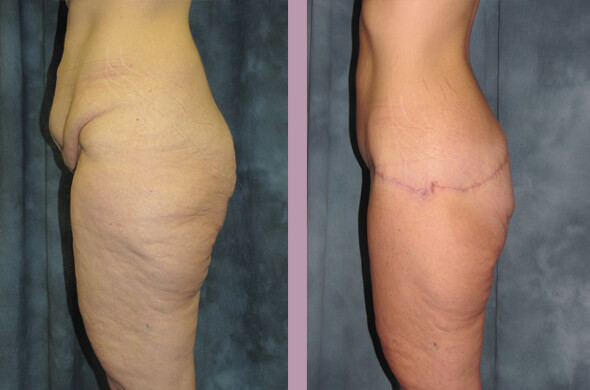 Case--831 | Before and After Body Lift 2