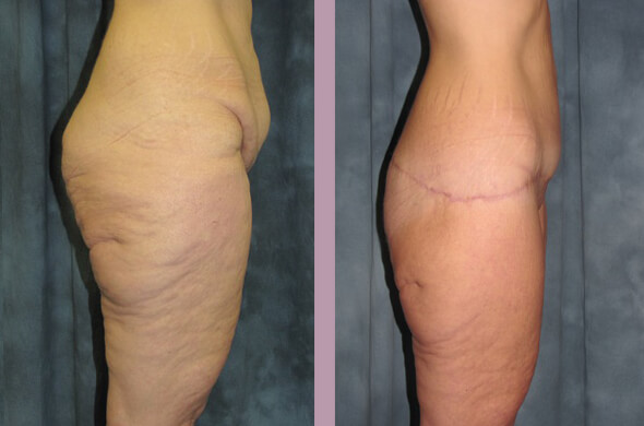 Case--831 | Before and After Body Lift 3