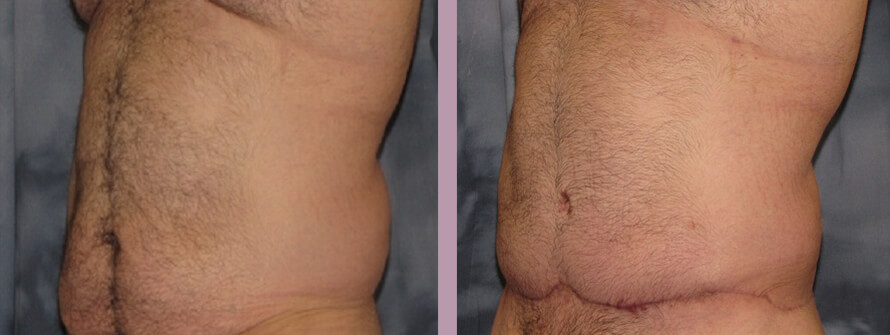 Case--844 | Before and After Body Lift 2