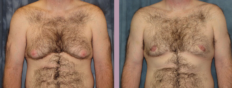 Case--1320 | Before and After Gynecomastia